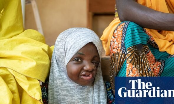 Sakina, una sobreviviente de seis años de la enfermedad conocida como noma del estado de Sokoto en Nigeria. Foto: Claire Jeantet/Fabrice Caterini/Inediz