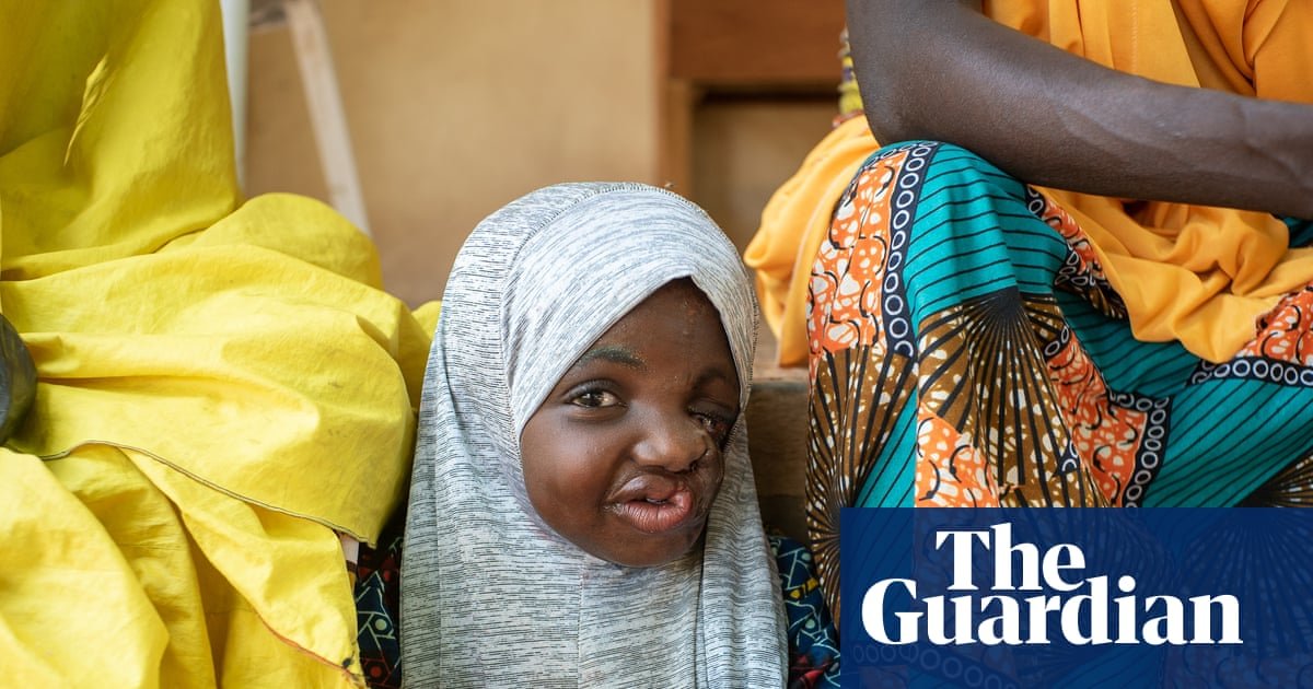 Sakina, una sobreviviente de seis años de la enfermedad conocida como noma del estado de Sokoto en Nigeria. Foto: Claire Jeantet/Fabrice Caterini/Inediz