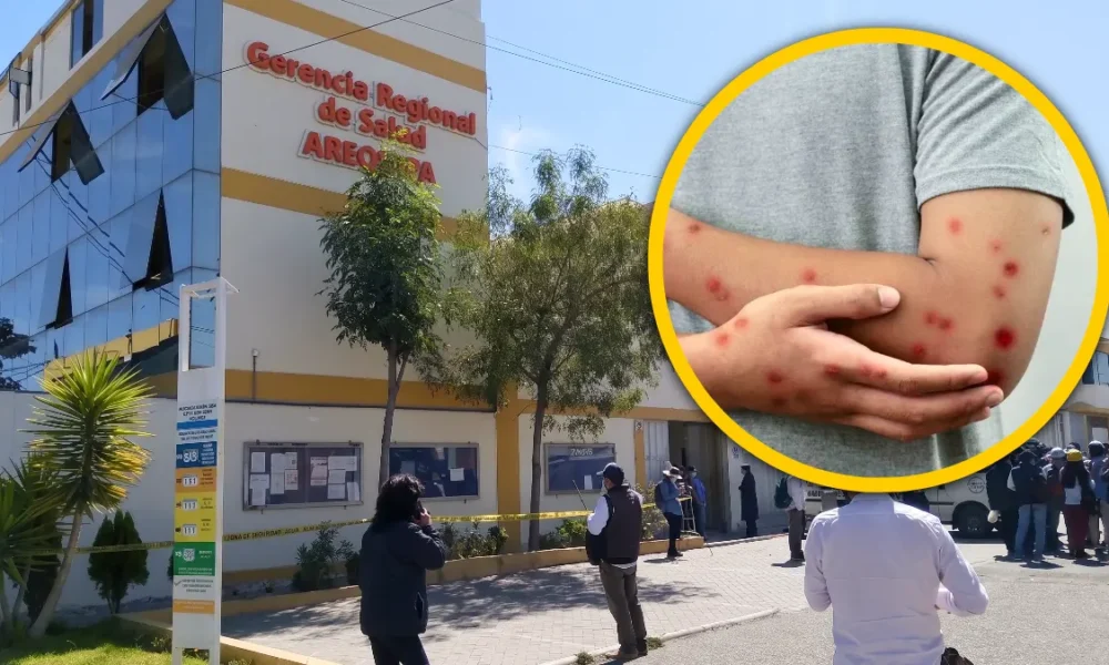 Arequipa confirma aumento — Imagen de la cobertura sobre Casos confirmados de sarampión aumentan a 13 en Arequipa y la mayoría de contagi. Foto de: El Búho